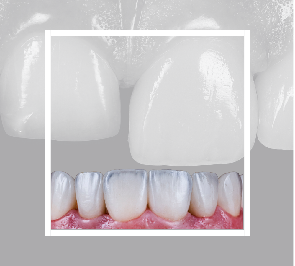 Composite Veneers / Bonding