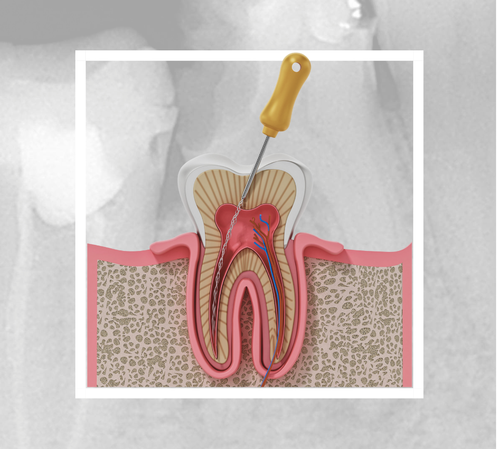 Root Canal Treatment