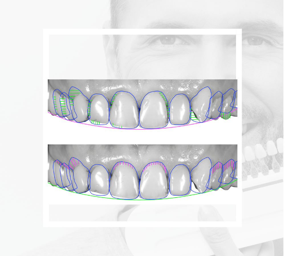 Smile Design Treatment